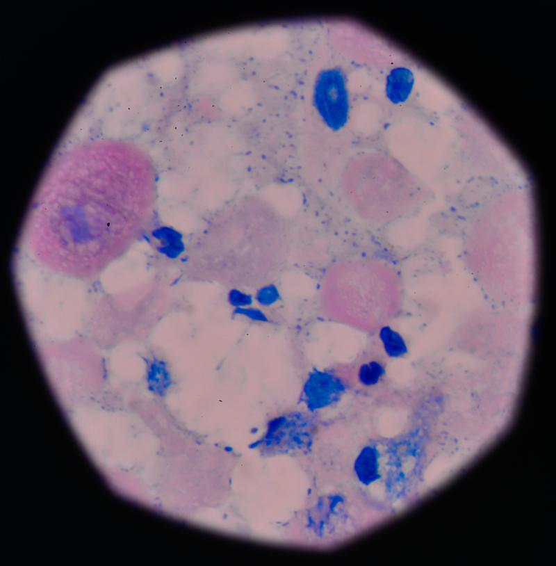 非典型鳞状细胞是什么意思