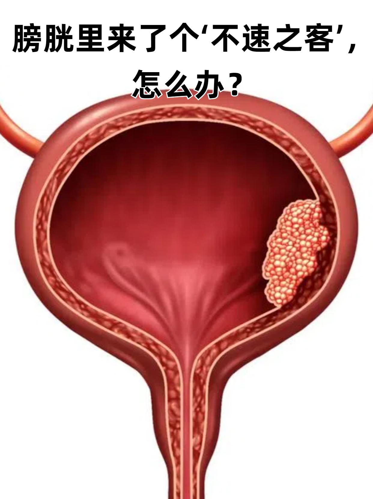 膀胱癌早期症状有哪些?