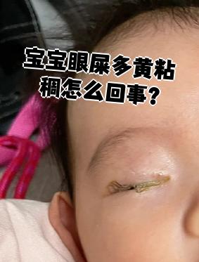 婴儿眼睛有眼屎