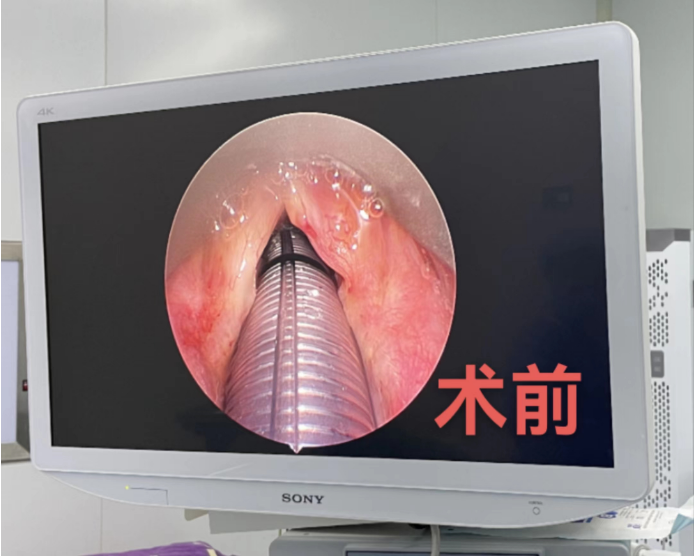 声带息肉怎么做手术