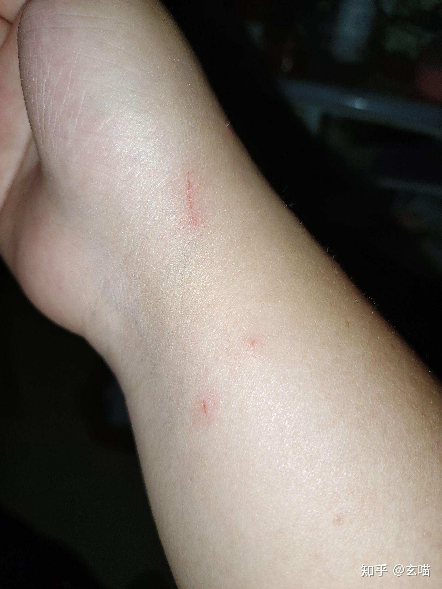 被猫咬出血了,需要打针吗?