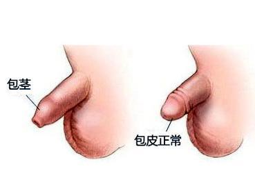 什么是包皮包茎
