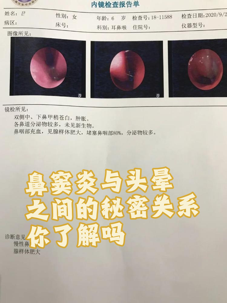 慢性鼻窦炎有哪些症状