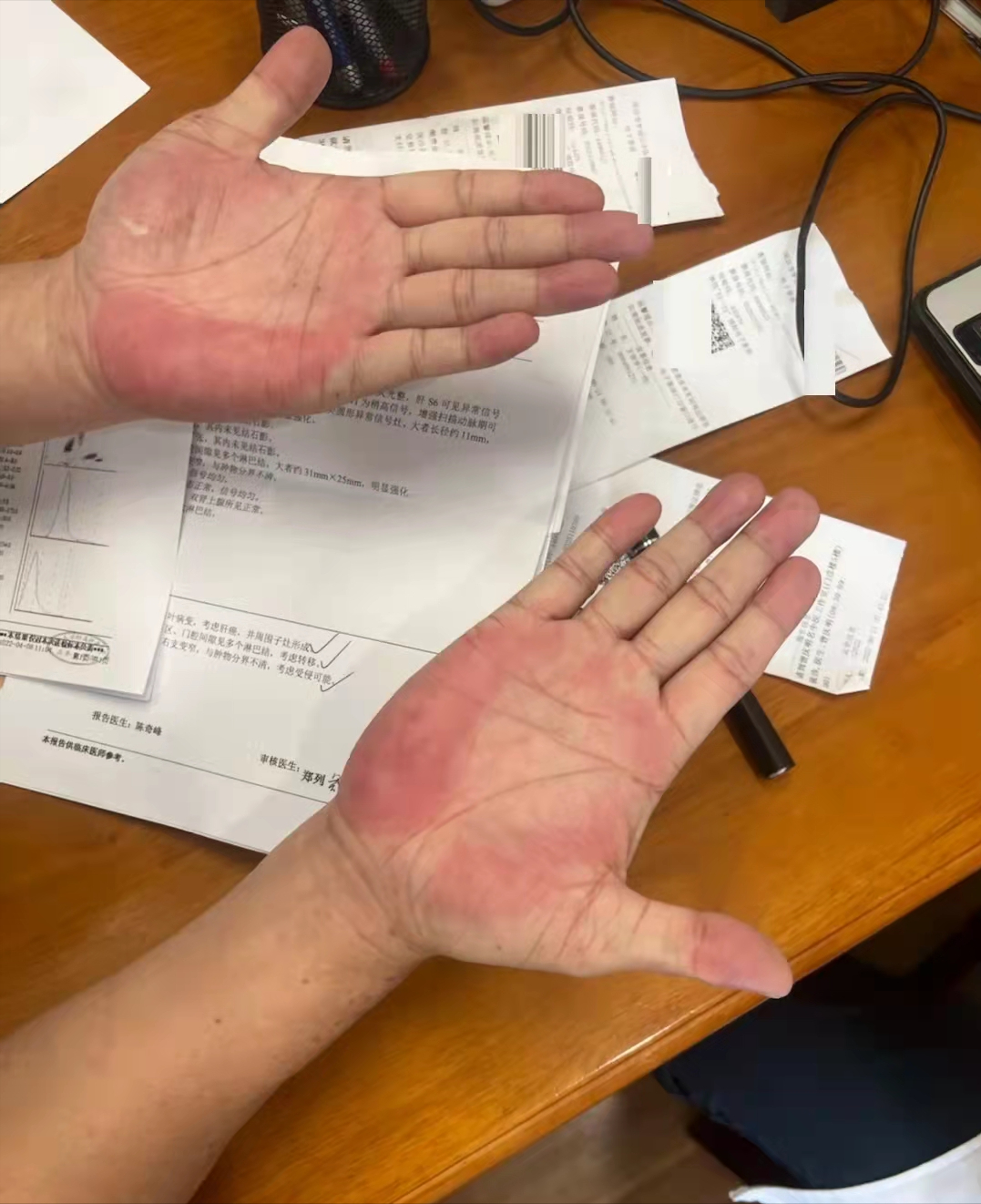 手掌发黄是肝病吗