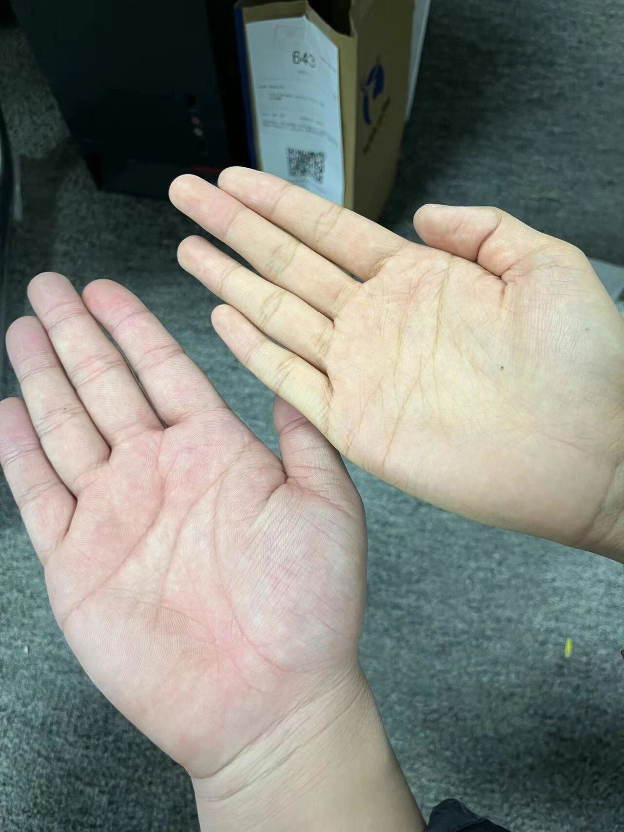 手掌发黄是肝病吗