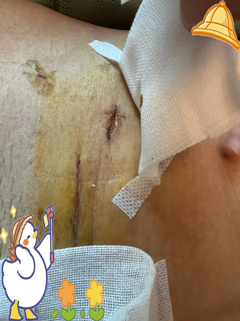 侧切第十天伤口恢复情况