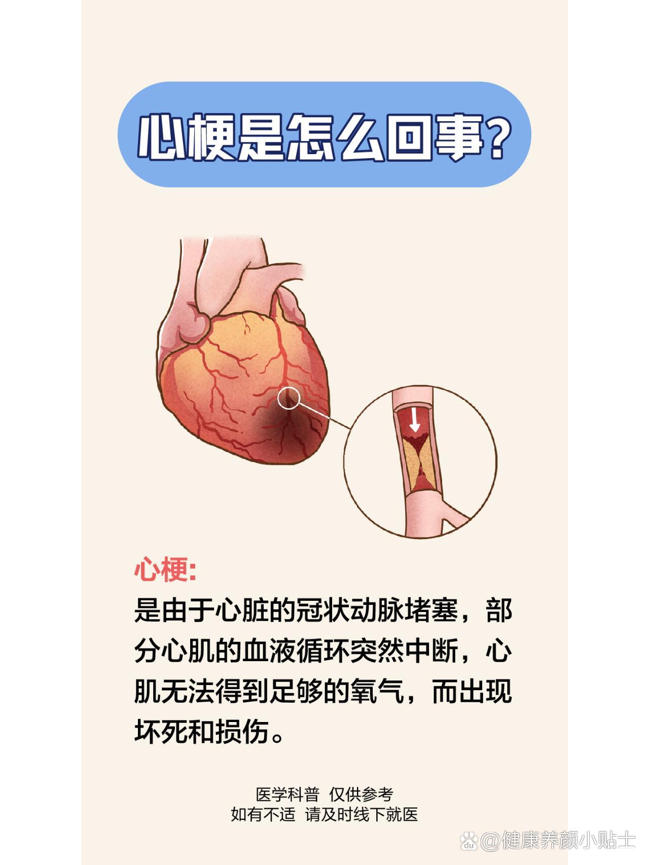 心梗有什么前兆症状