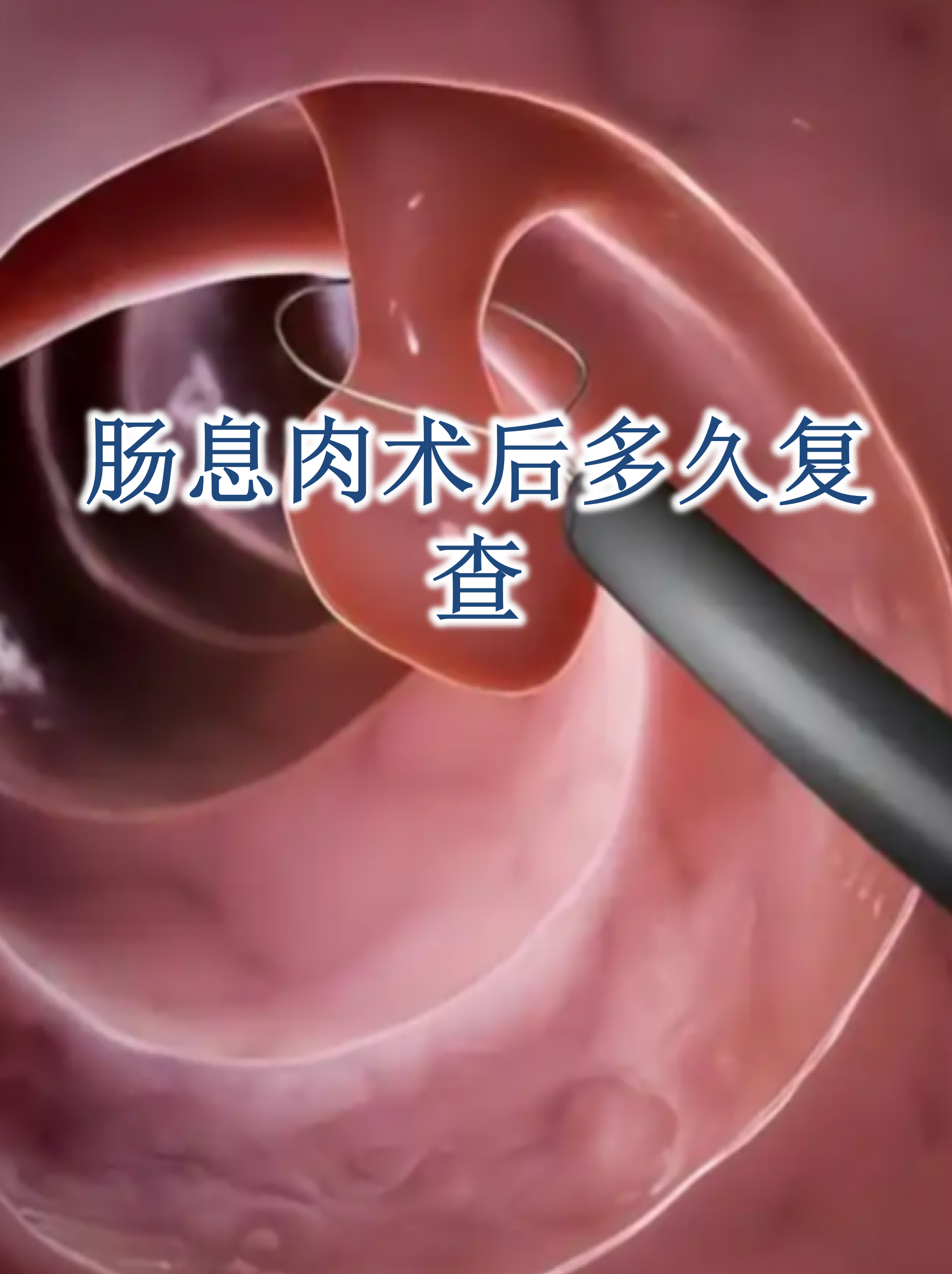 结肠息肉手术