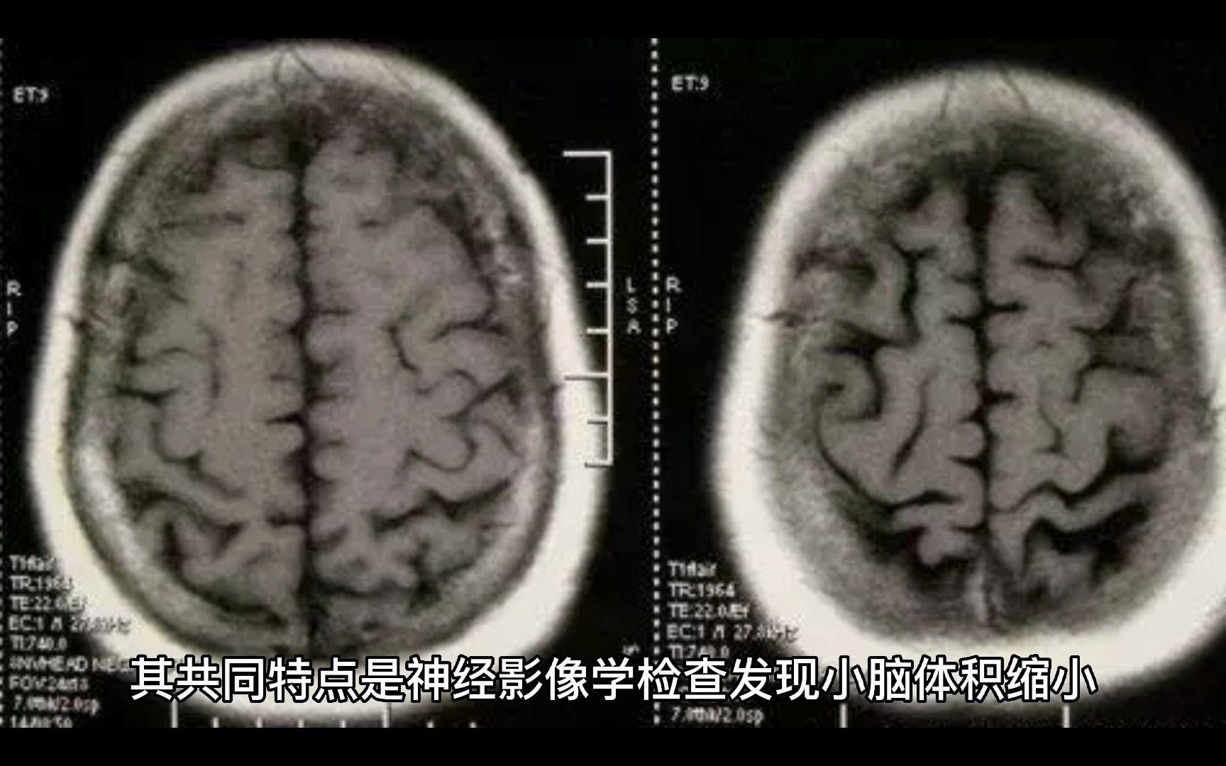 小脑萎缩都有哪些症状