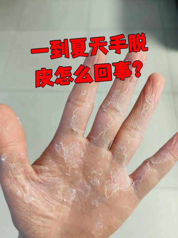 什么是手癣?