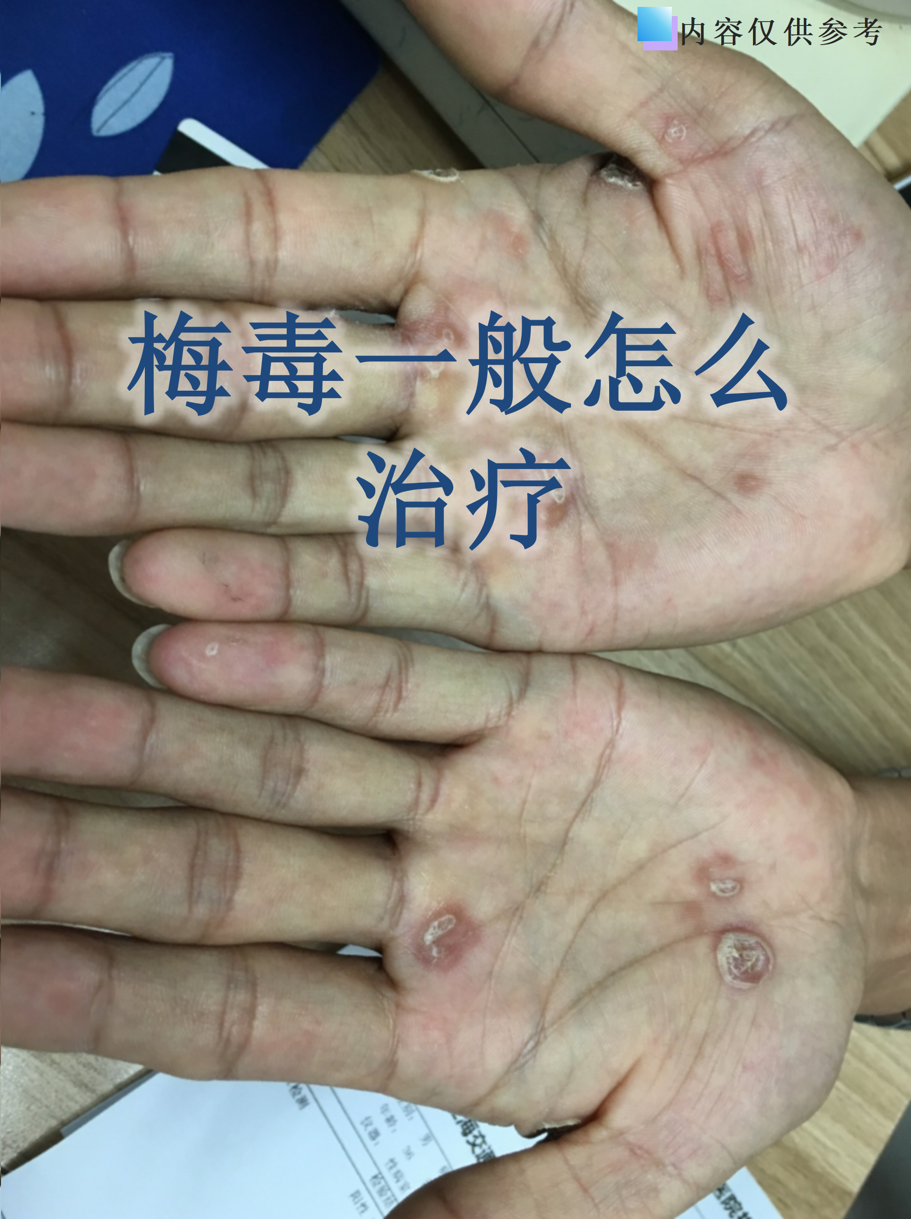 硬下疳是什么样的