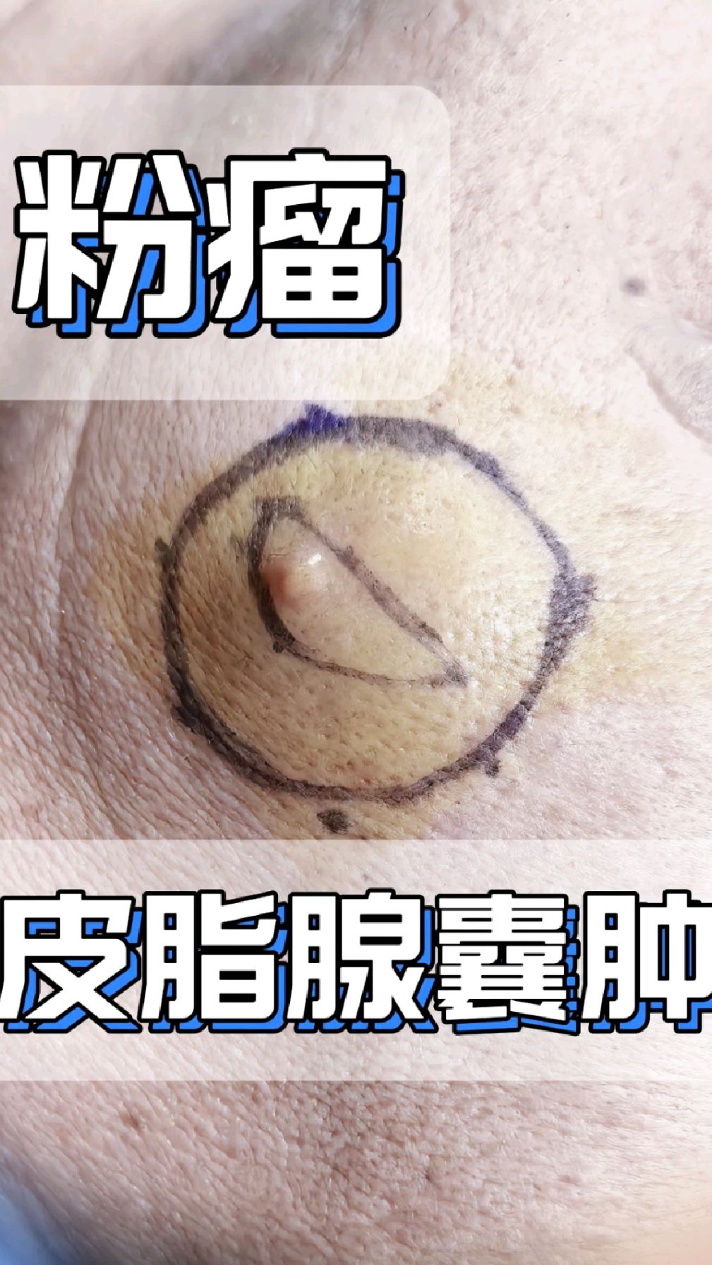 粉瘤不切除有什么危害