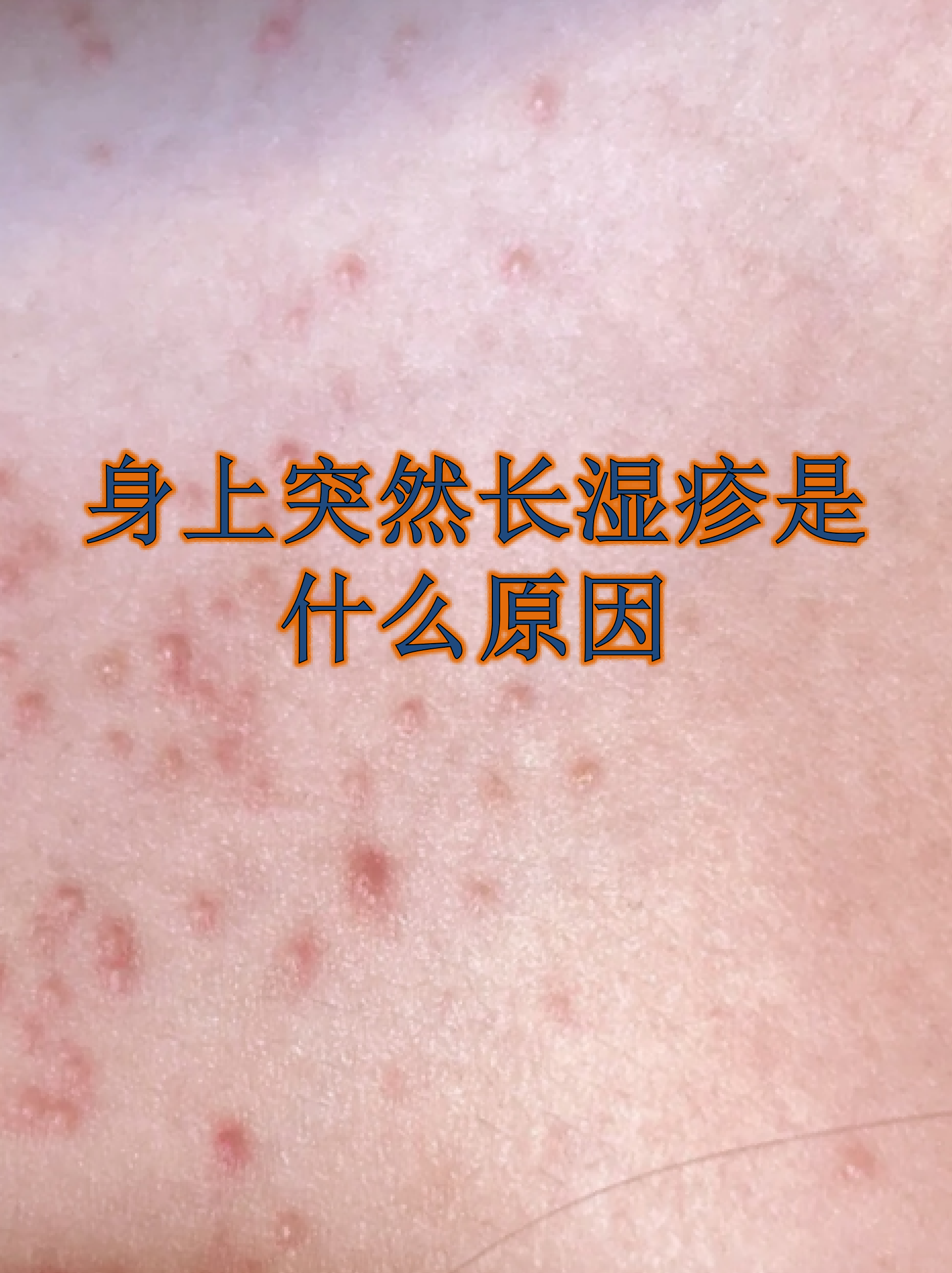 身上起湿疹怎么回事