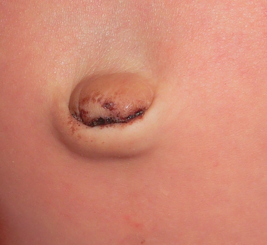 新生儿肚脐出血是怎么回事?