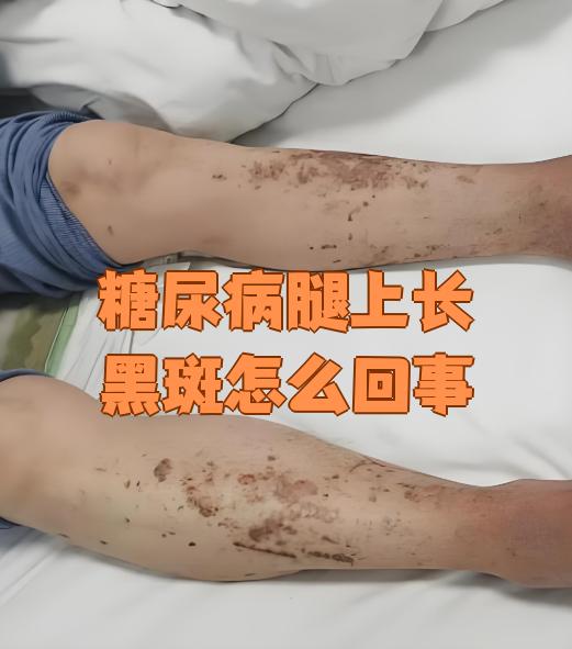 糖尿病的早期症状男人