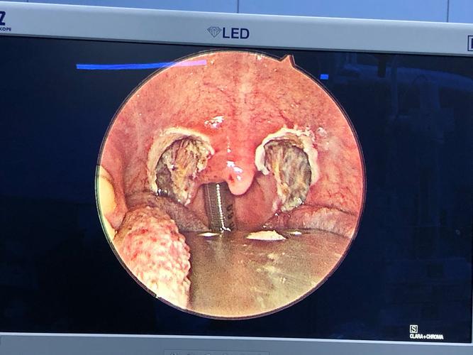 扁桃体手术切除的危害有哪些