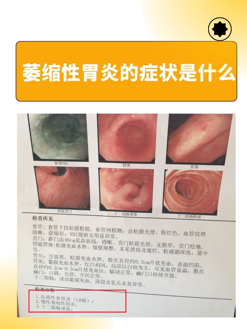 急性胃炎的症状表现有哪些