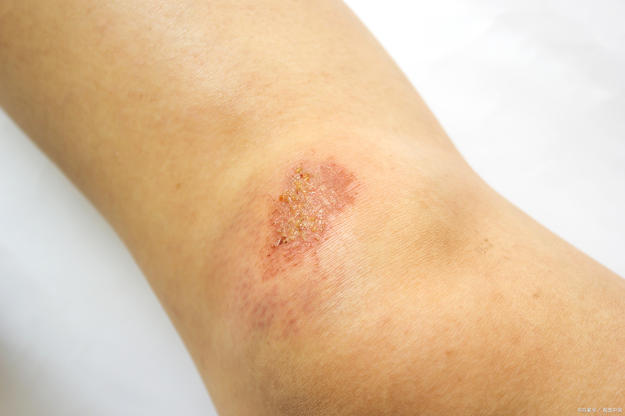 破伤风的伤口有什么症状?