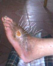 脉管炎的早期症状有哪些