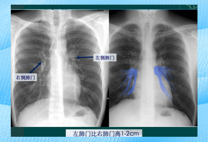 心影增大是什么问题?