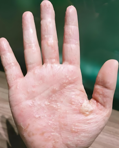 身上长透明的水泡