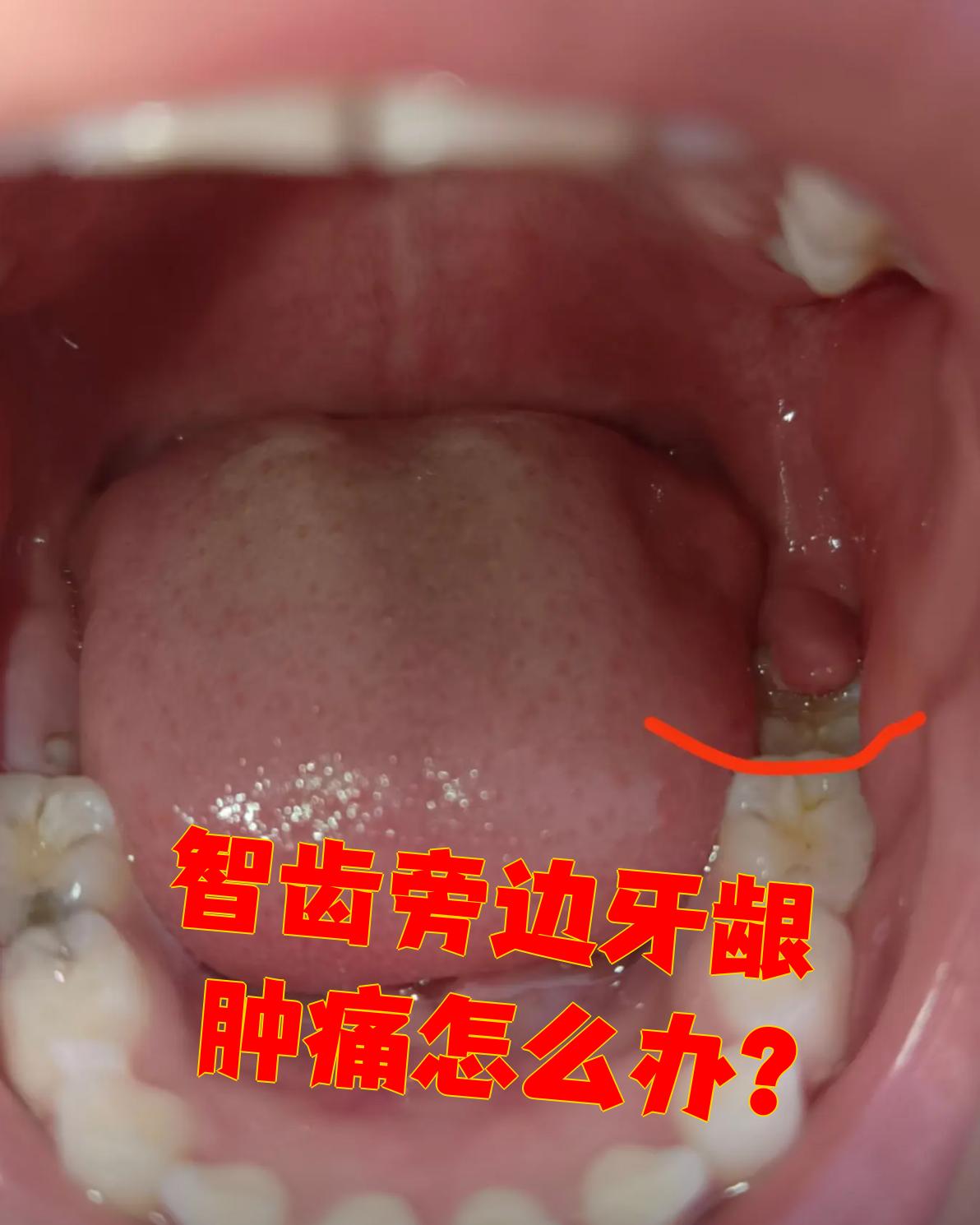 智齿发炎怎么办?