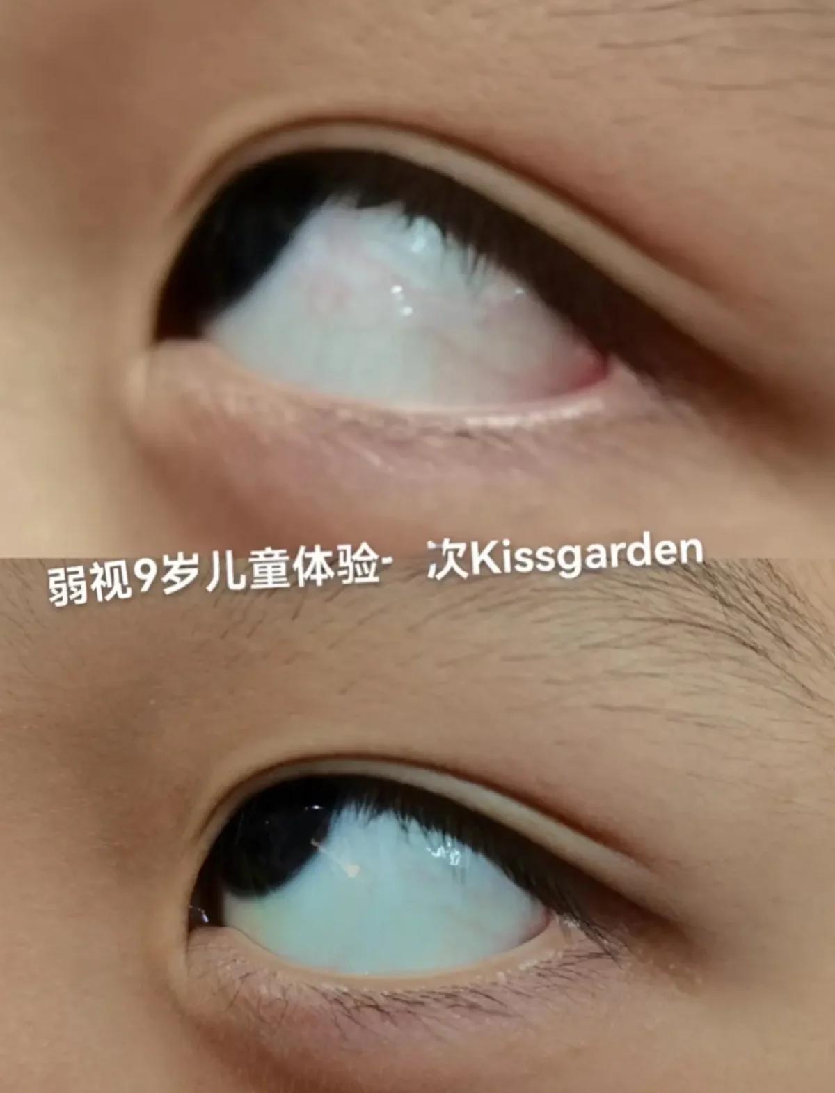 白眼球充血是怎么回事