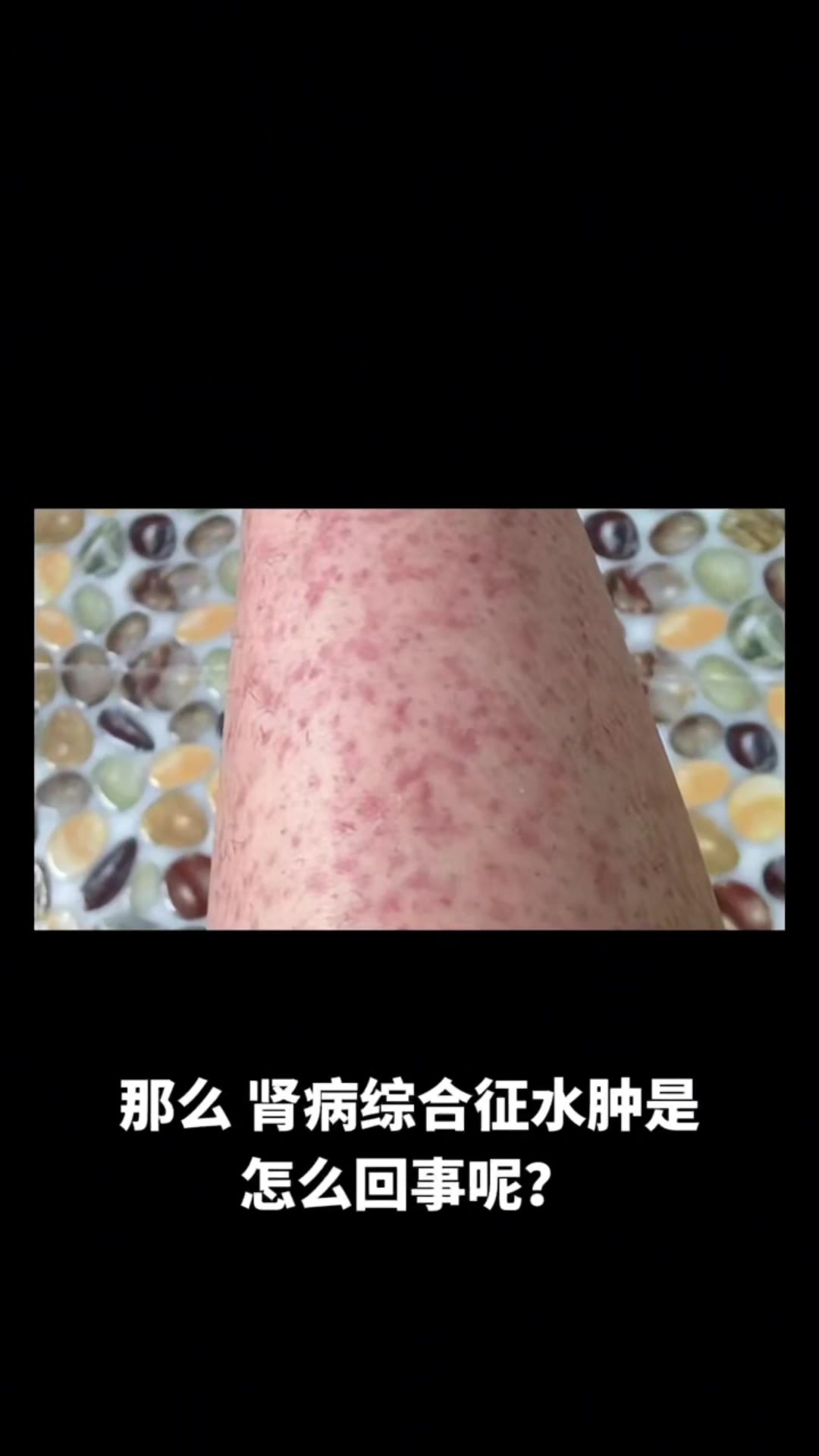 慢性肾炎的早期症状都有什么?