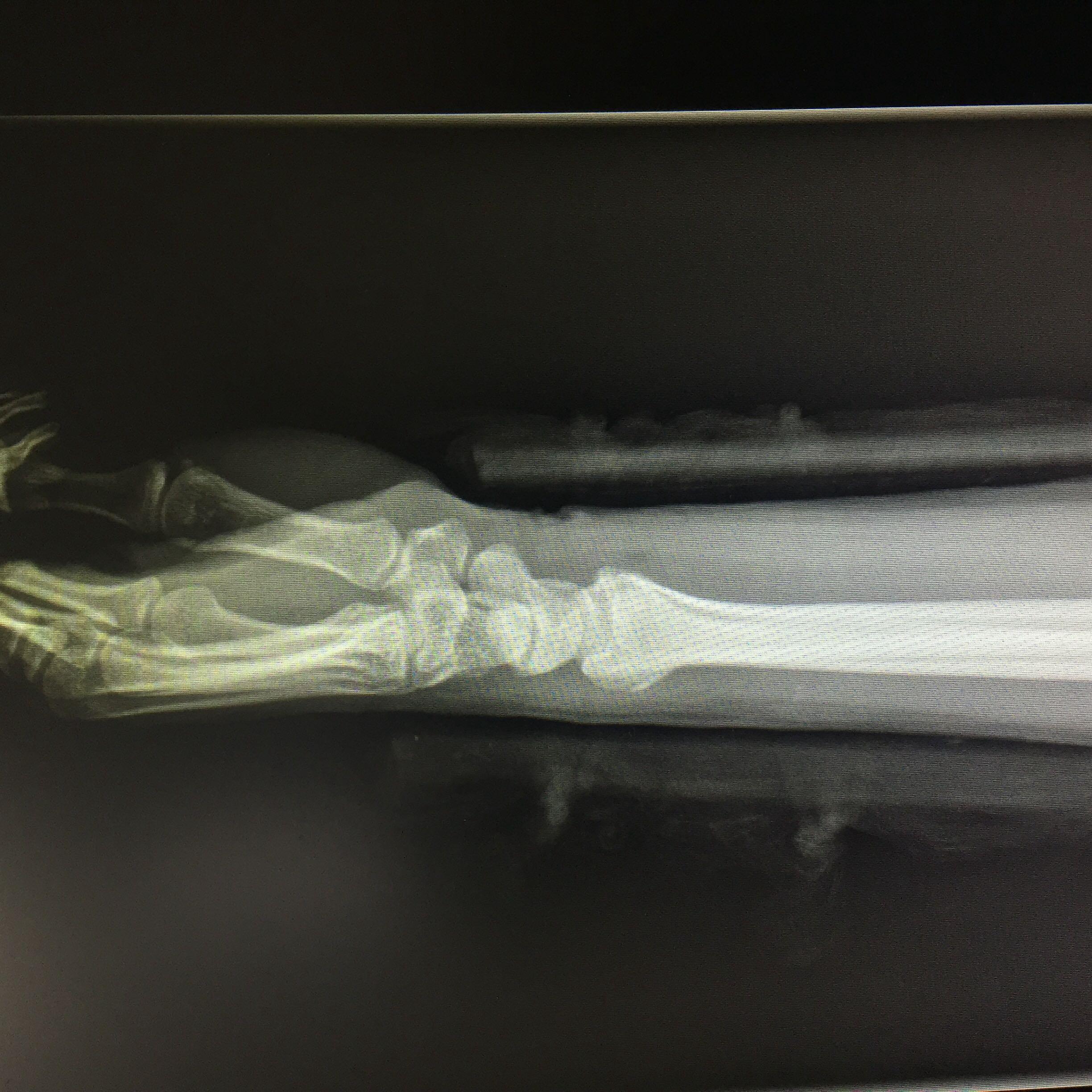 colles骨折手法复位