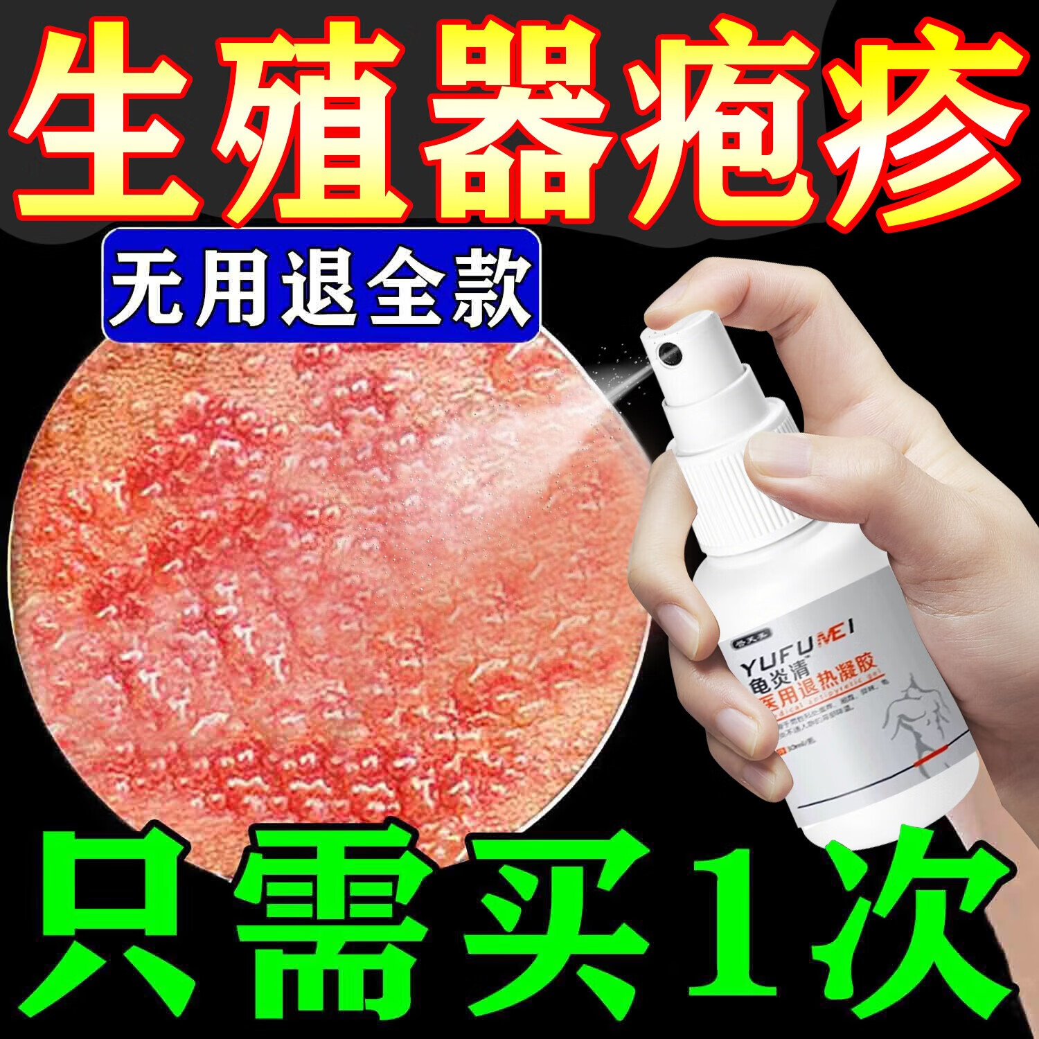 龟头疱疹如何治疗