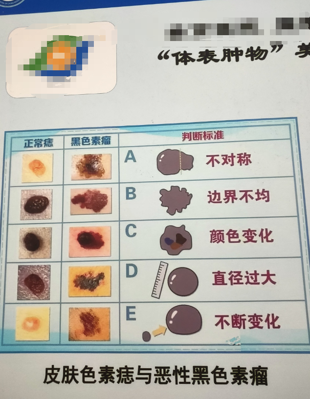 每天一问,黑色素瘤的误诊几率有多大.