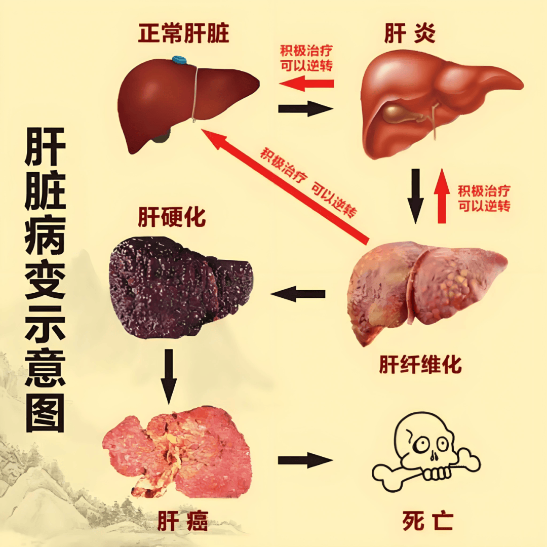 肝硬化并发症有哪些