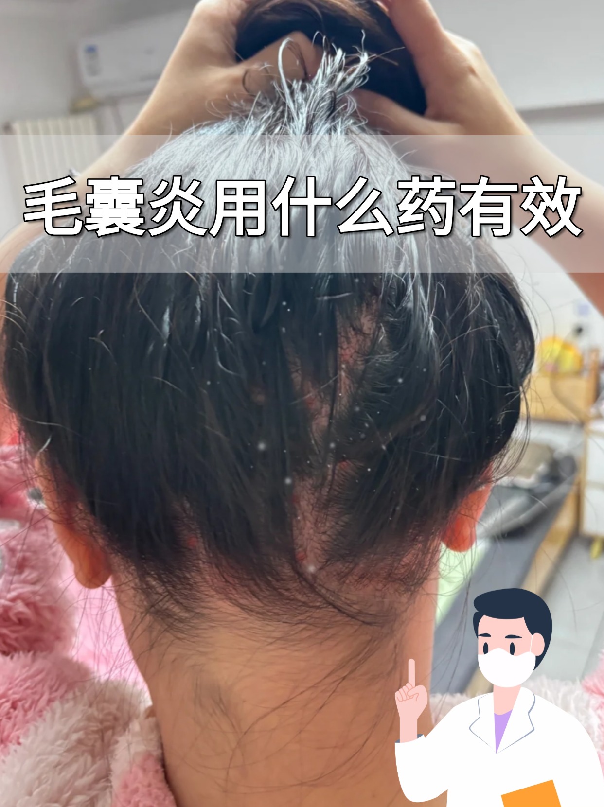 毛囊炎怎么治疗效果最佳?