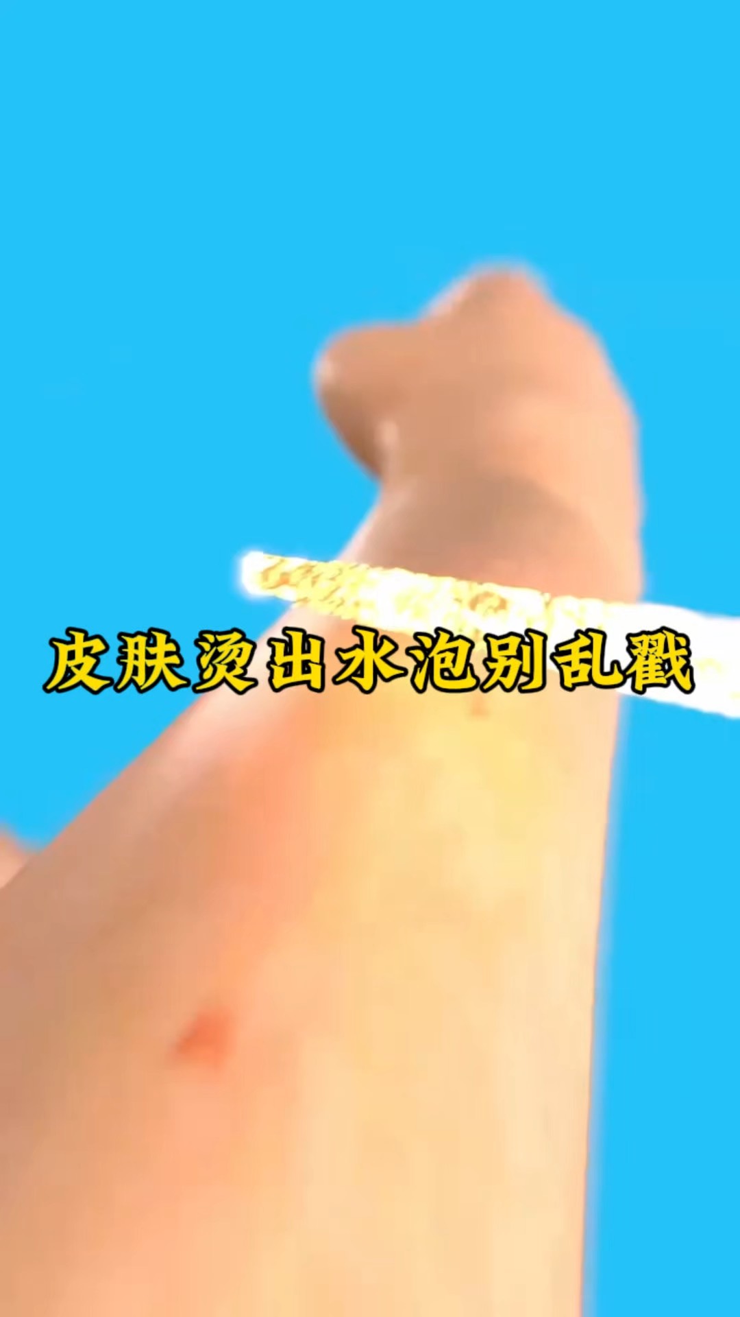 烫出水泡怎么办