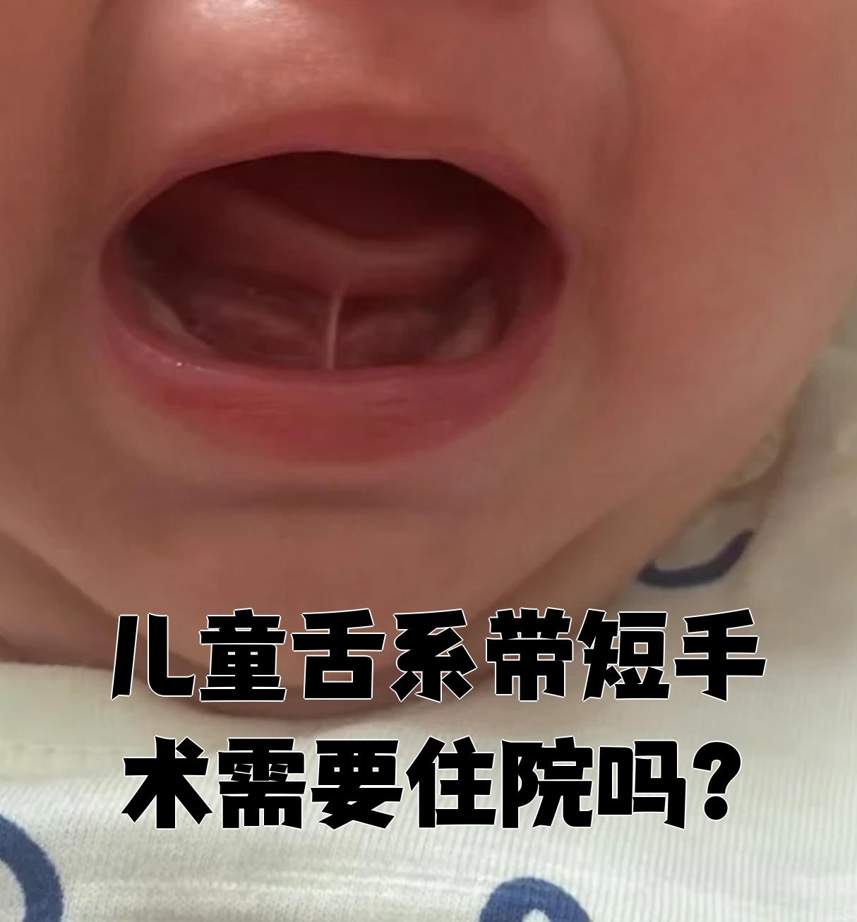 如何判断孩子舌系带短,照片请看下