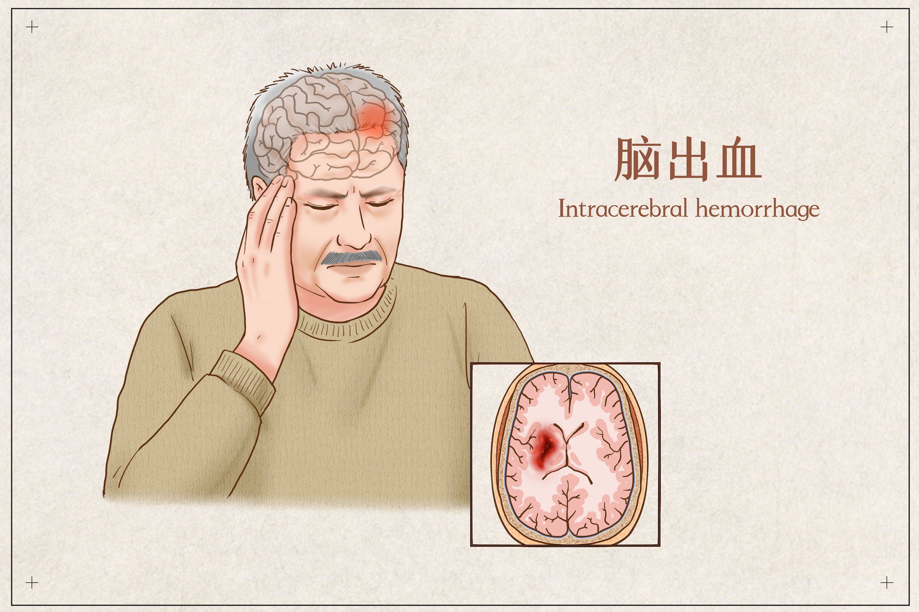 脑干出血是什么原因造成的