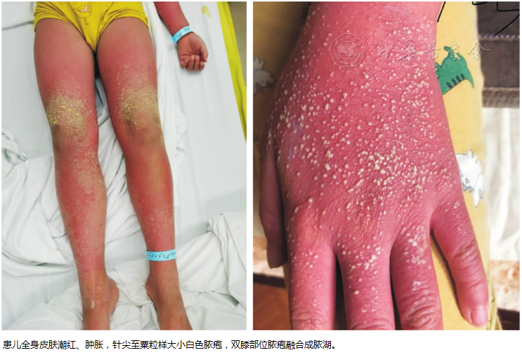 小孩脓毒血症什么症状