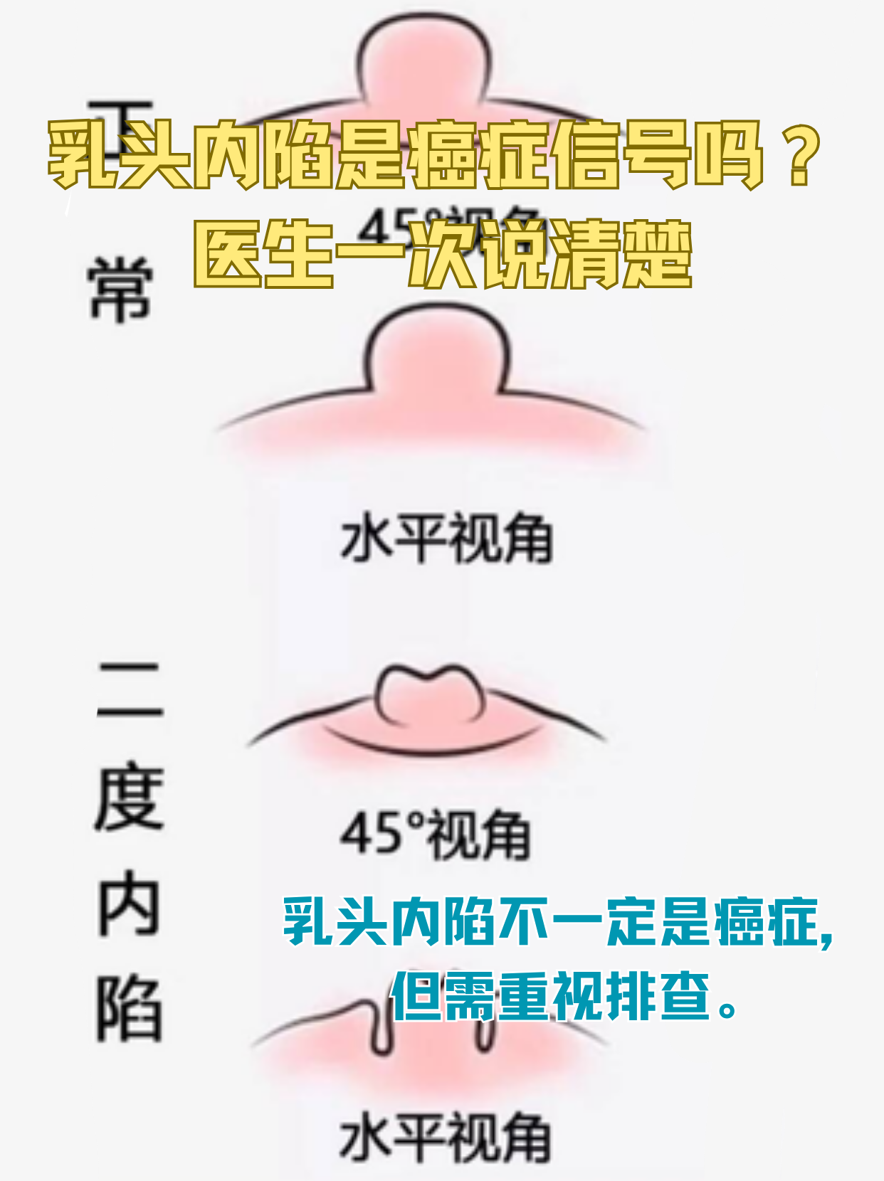 乳腺癌前征兆什么样的