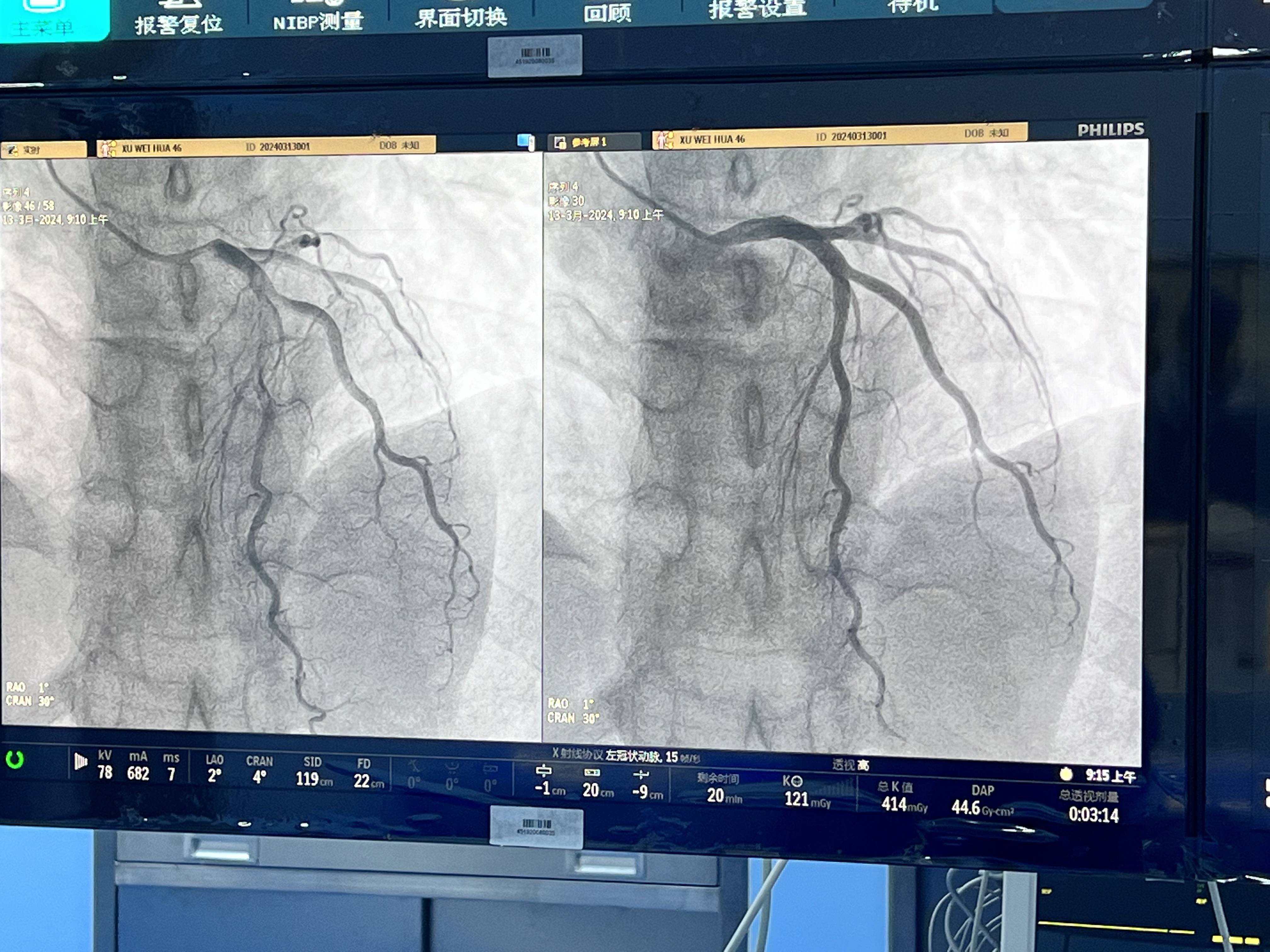 血管造影是什么