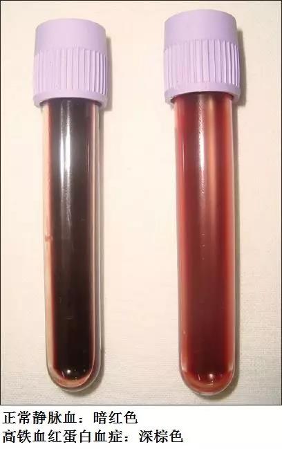 高铁血红蛋白血症的临床表现