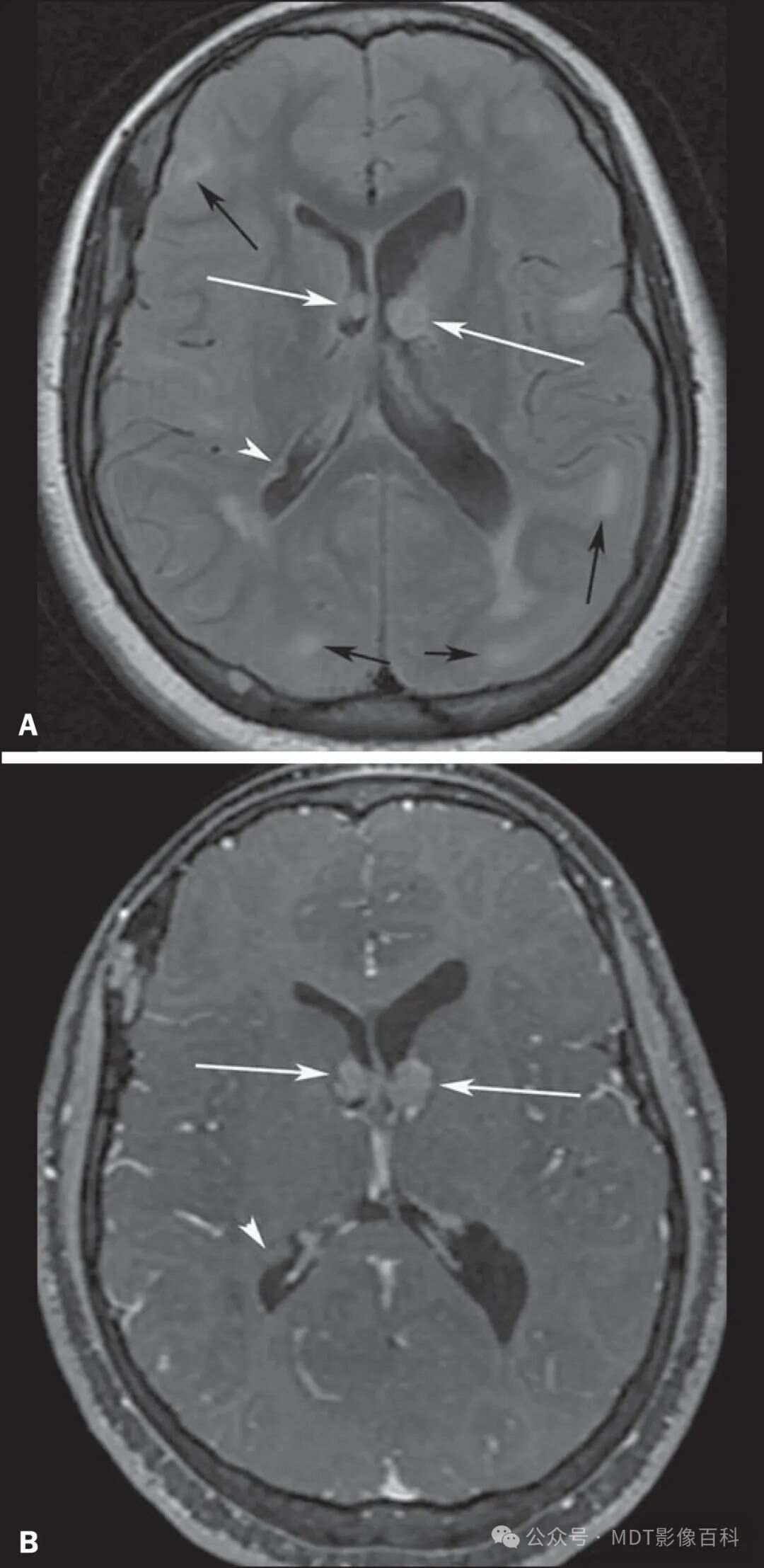 什么是结节性硬化症?