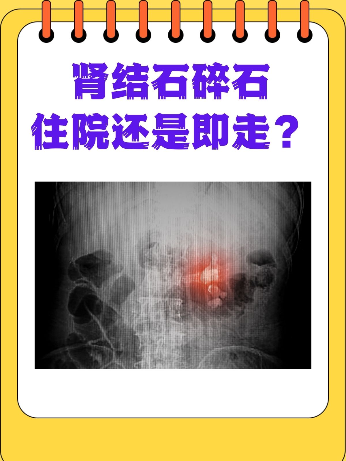 肾结石碎石要多少钱?