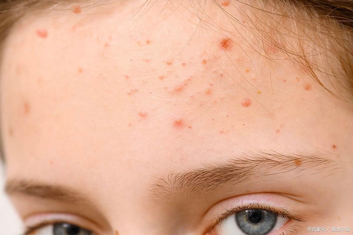 青春痘一般长到几岁