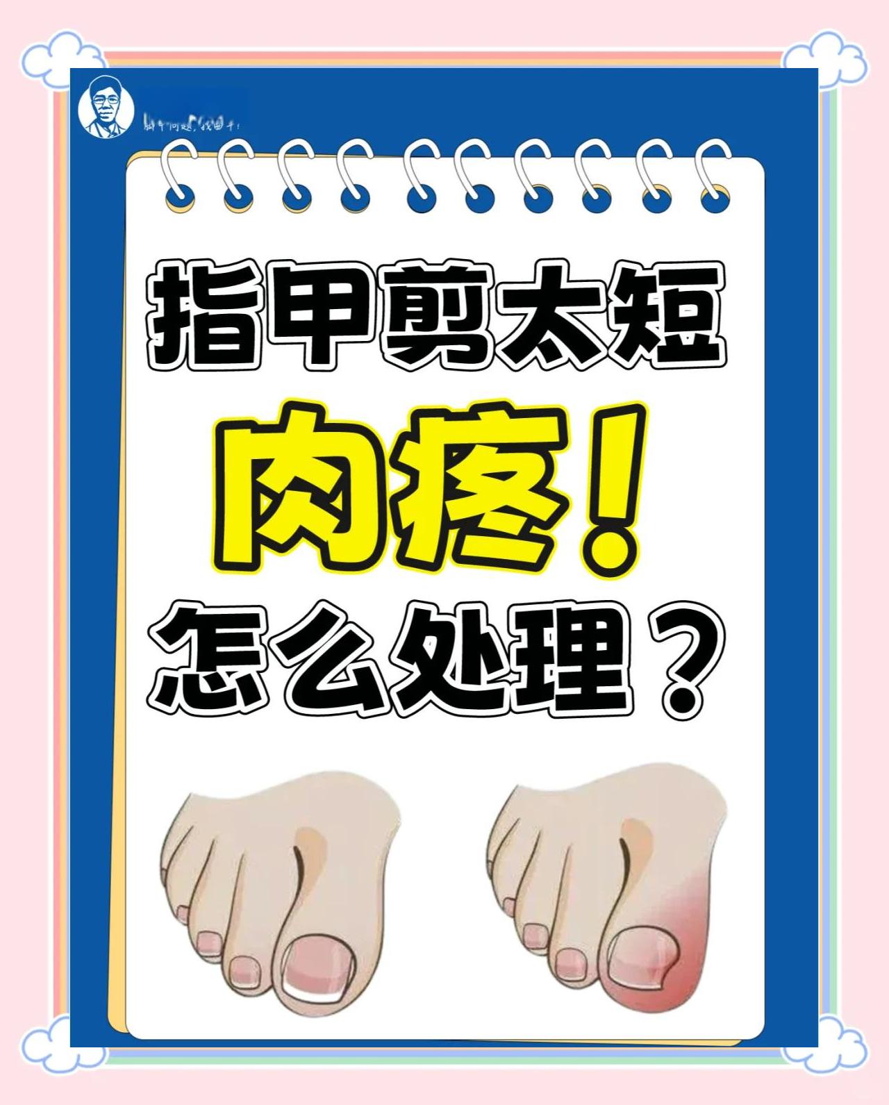 脚趾甲脱落了怎么办