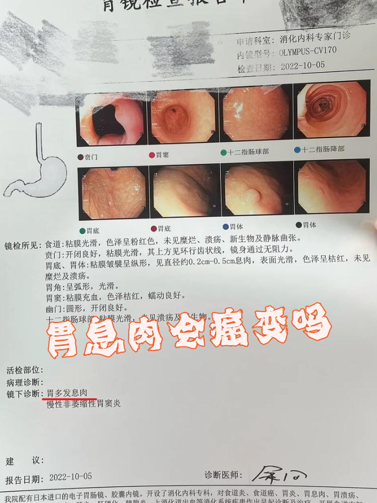 胃息肉怎么引起的