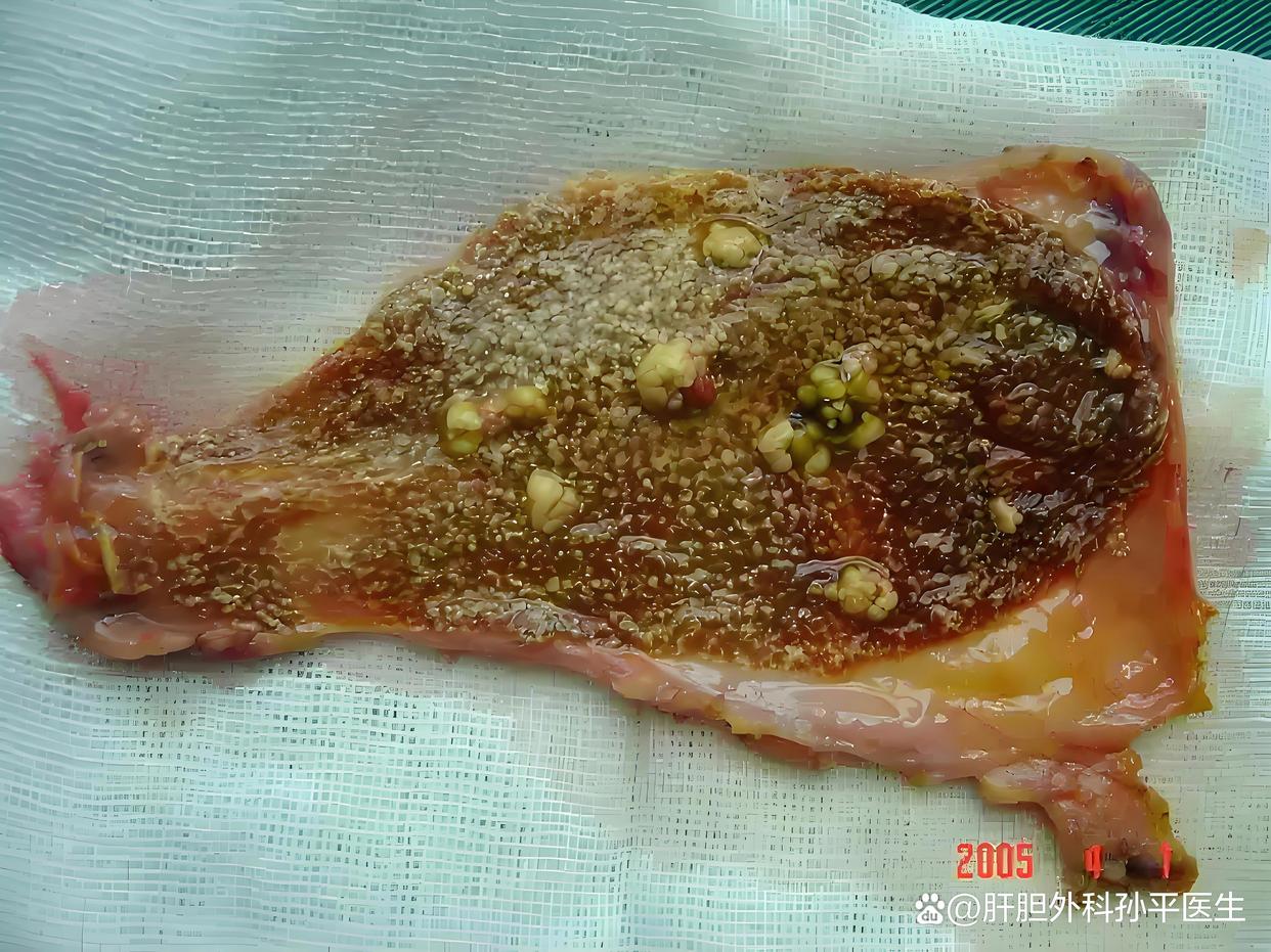 胆结石可以吃鸡蛋吗？