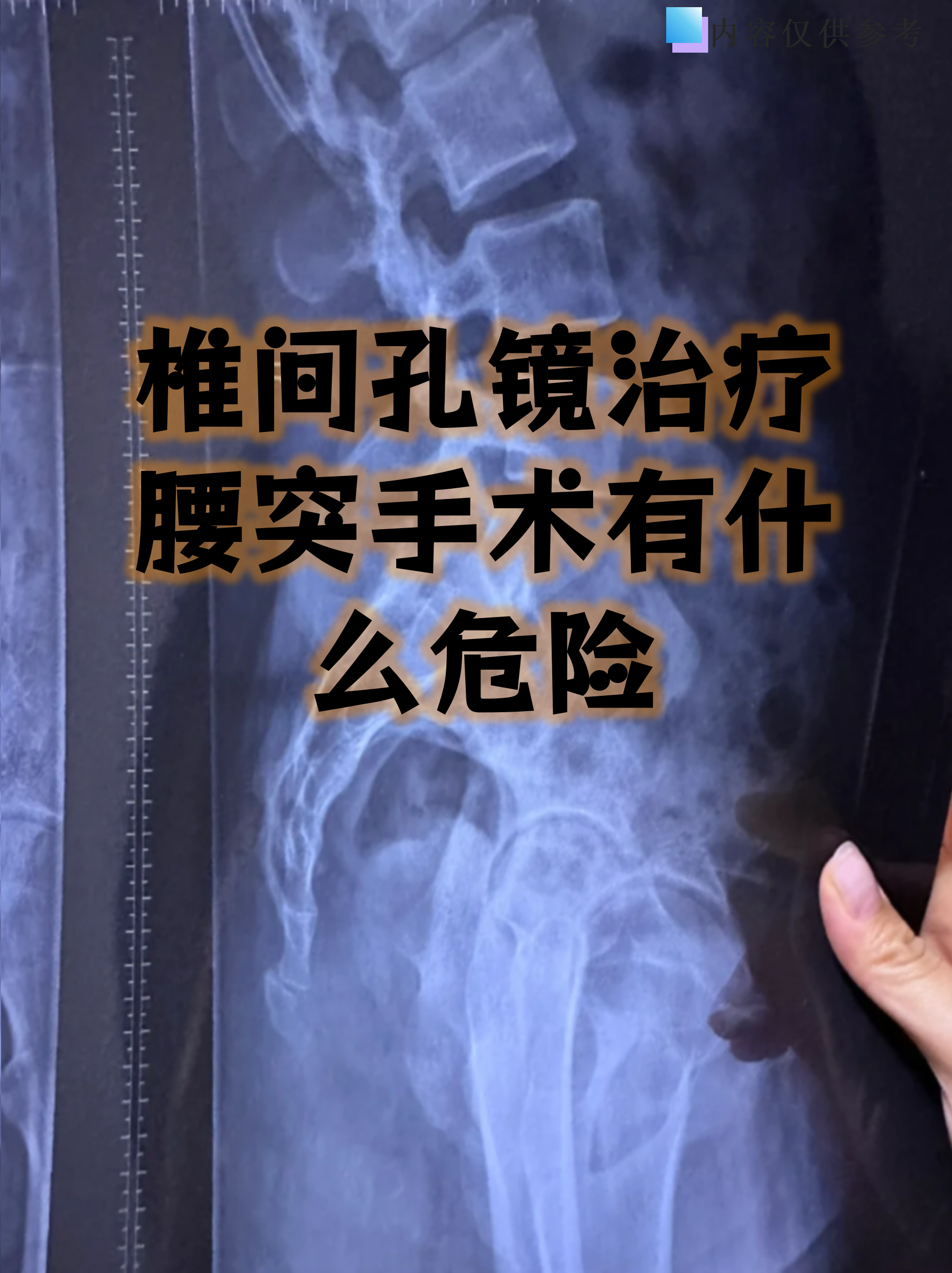 腰椎骨质增生可以根治吗