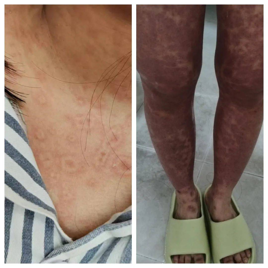 患上药疹怎么治疗快呢