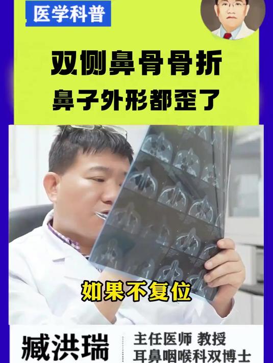鼻骨骨折严重吗?