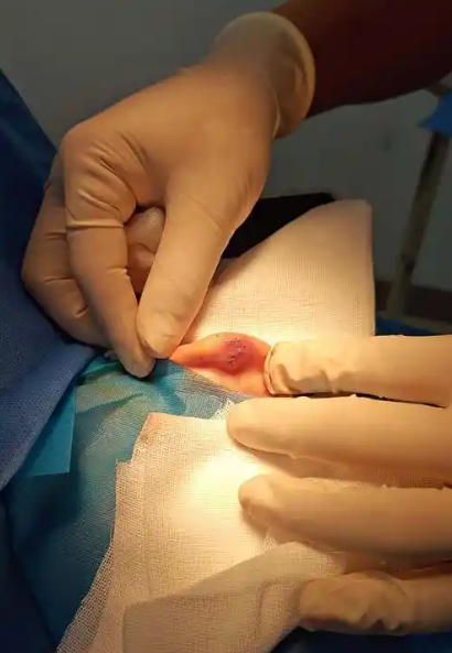 女性巴氏腺囊脓